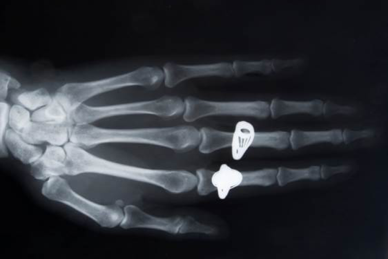 an x ray of a hand wearing rings